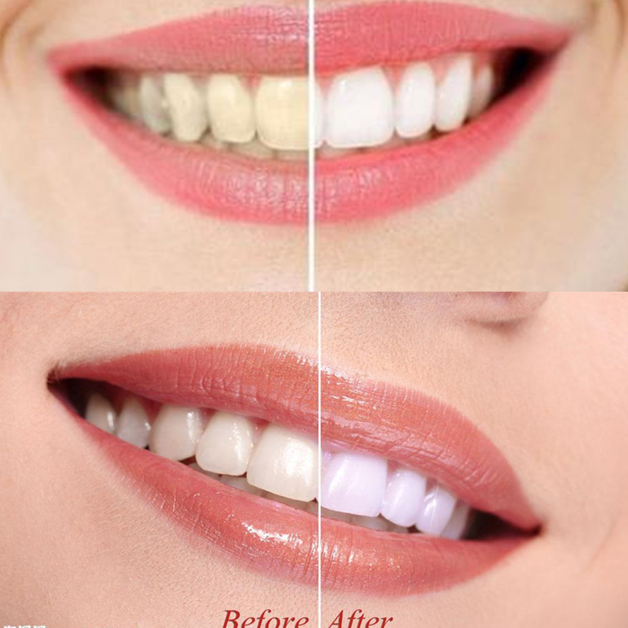 Bambus Holzkohle Zähne Zahn De – Teeth Whitening Singapore Bewertung und Preis