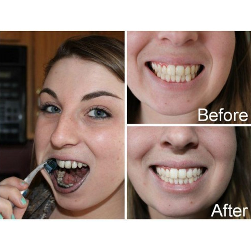 Bambus Holzkohle Zähne Zahn De – Teeth Whitening Singapore Bewertung und Preis
