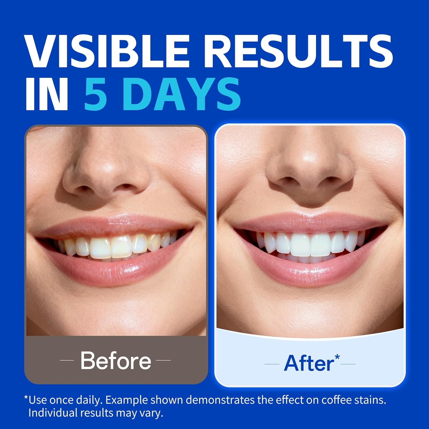7 Paar Zahnaufhellungsstreifen – Teeth Whitening Street Bewertung und Preis