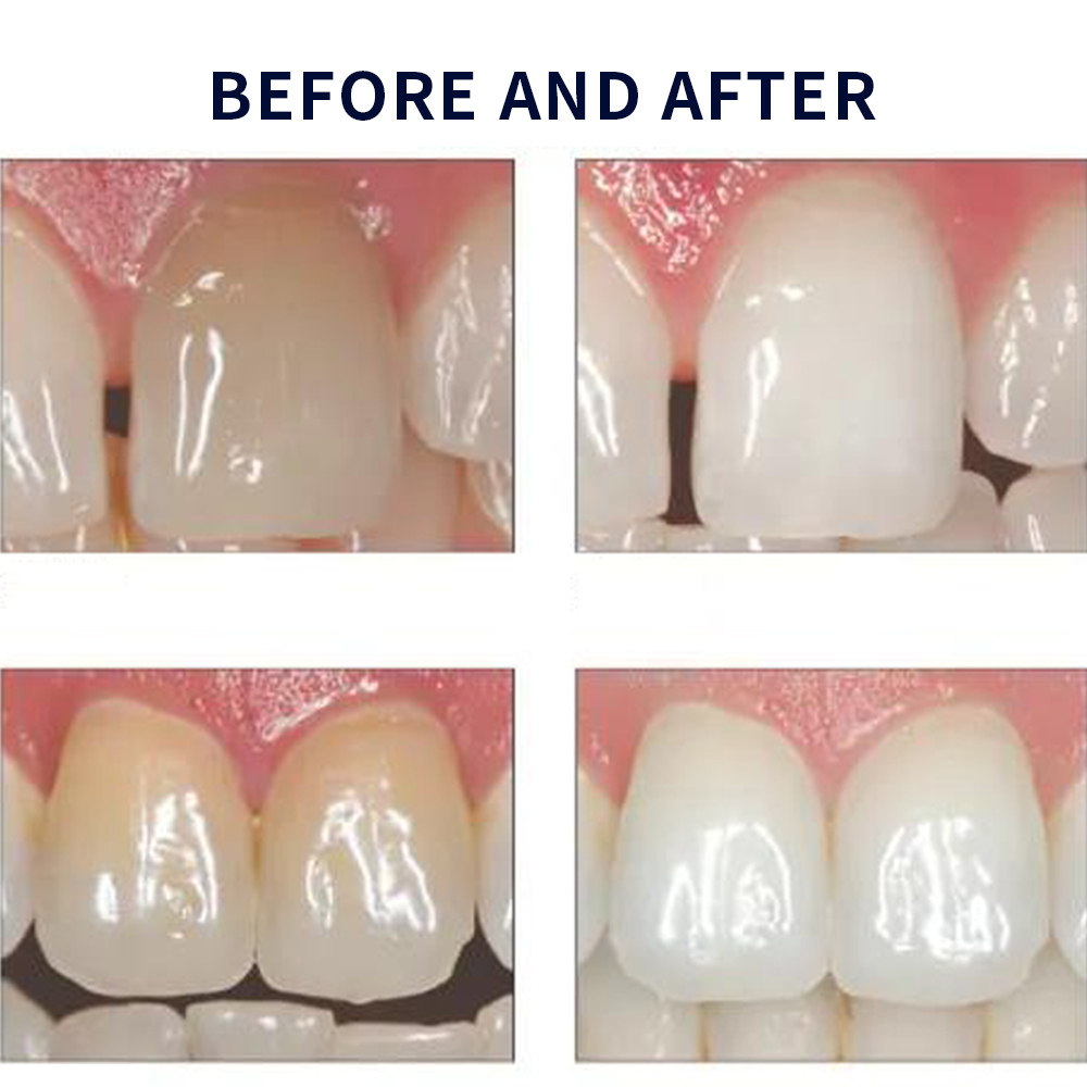 Opale scence White ning 1,2 pf – Teeth Whitening Doctor Bewertung und Preis