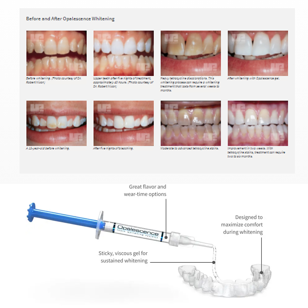 Opale scence White ning 1,2 pf – Teeth Whitening Doctor Bewertung und Preis