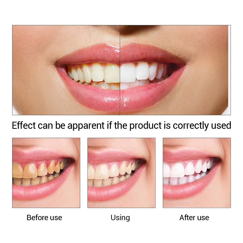 FTEENPLY Zahnaufhellung Essenz – Teeth Whitening Street Bewertung und Preis