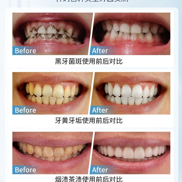 Japan Manuelle Zahnfleckenentf – Teeth Whitening In Japan Bewertung und Preis